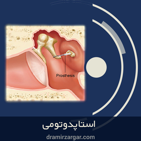 استاپدوتومی https://dramirzargar.com/
