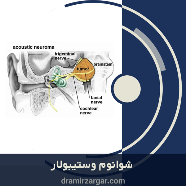 جراحی شوانوم وستیبولار https://dramirzargar.com/