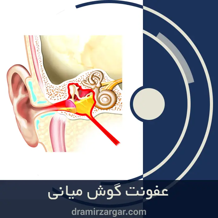 عفونت گوش میانی https://dramirzargar.com/
